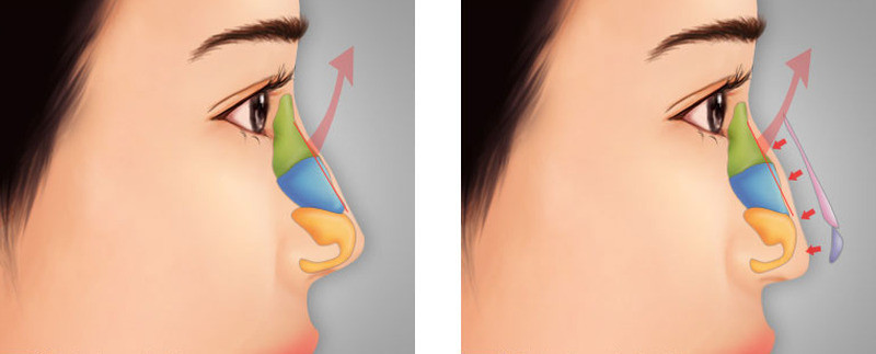Gồ mũi do nguyên nhân bên trong và bên ngoài gây ra