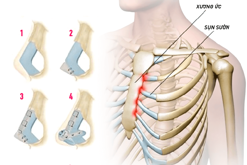 Sụn sườn dùng nâng đầu mũi