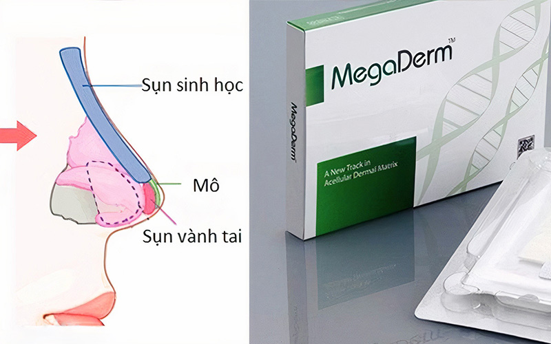 Sụn Megaderm nâng đầu mũi