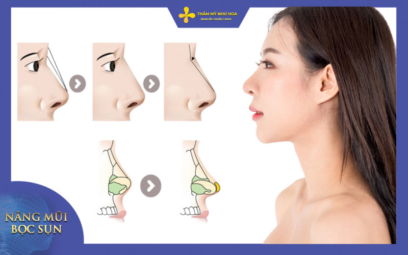 Tìm hiểu nâng mũi bọc sụn – Lựa chọn cho dáng mũi chuẩn đẹp tự nhiên