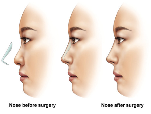 Tìm hiểu về phương pháp nâng mũi L Line 3D