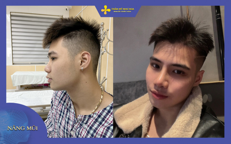 Hình ảnh khách hàng nam trước và sau nâng mũi L-line tại Như Hoa
