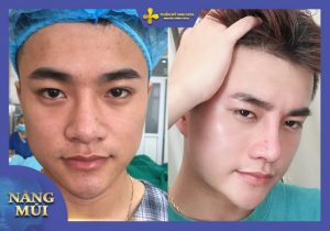 Hình ảnh khách hàng nam trước và sau nâng mũi L-line tại Như Hoa