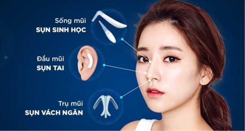 Sụn tự thân trong nâng mũi S Line 4D