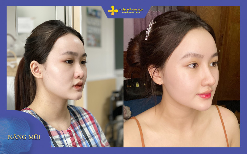 Nâng mũi S Line cao tây phù hợp với gương mặt người Châu Á, khắc phục khuyết điểm mũi hếch,.. 