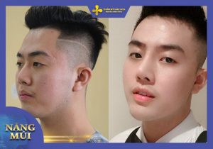 Những dáng mũi, khuyết điểm mũi nên lựa chọn phương pháp nâng mũi S Line cho nam