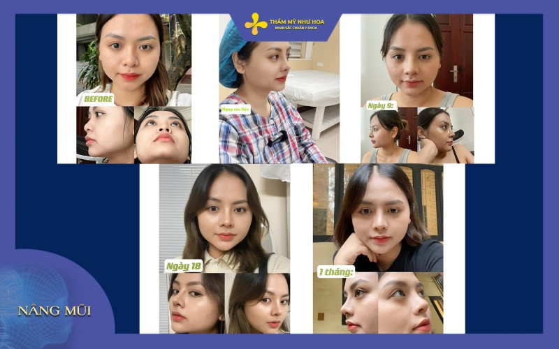 Hình ảnh các khách hàng nâng mũi surgiform nhân tạo toàn bộ tại thẩm mỹ Như Hoa
