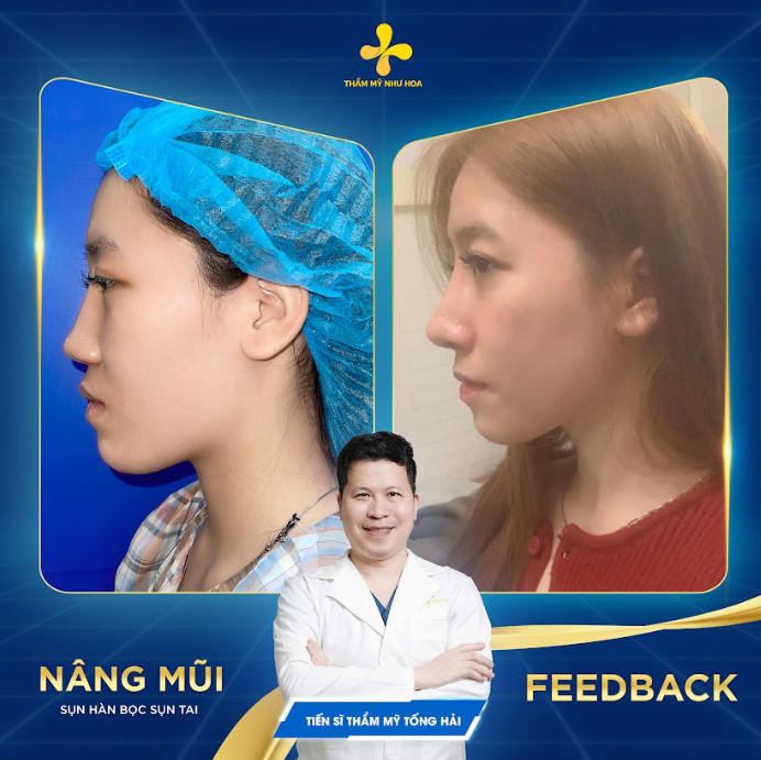 Những ca phẫu thuật nâng mũi S Line thành công mỹ mãn được chia sẻ từ clip nâng mũi s line 1