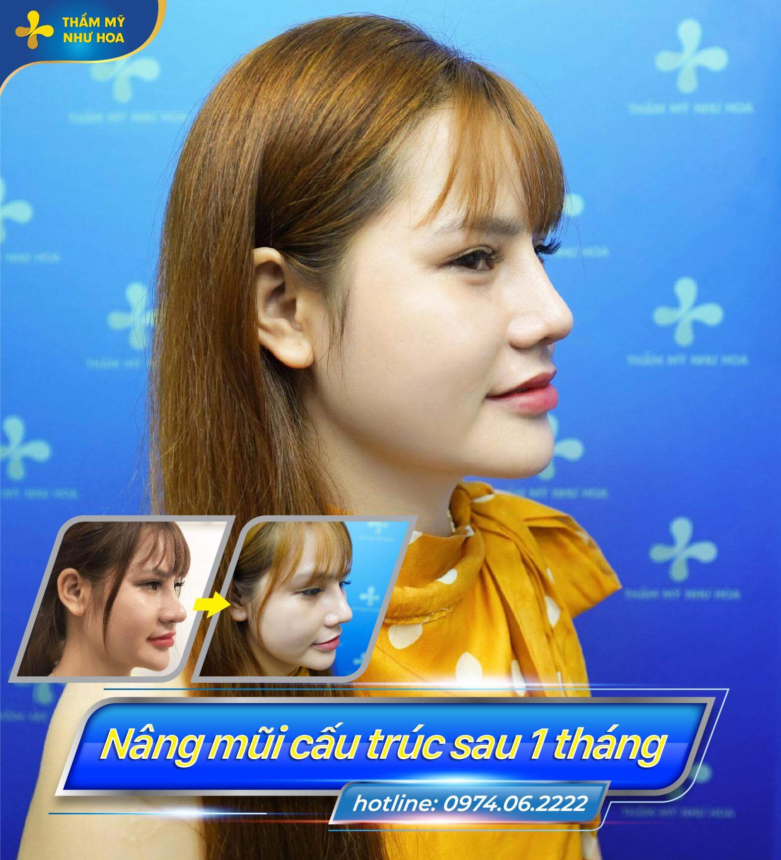 Những ca phẫu thuật thẩm mỹ sửa mũi chim ưng rất thành công của Thẩm mỹ Như Hoa