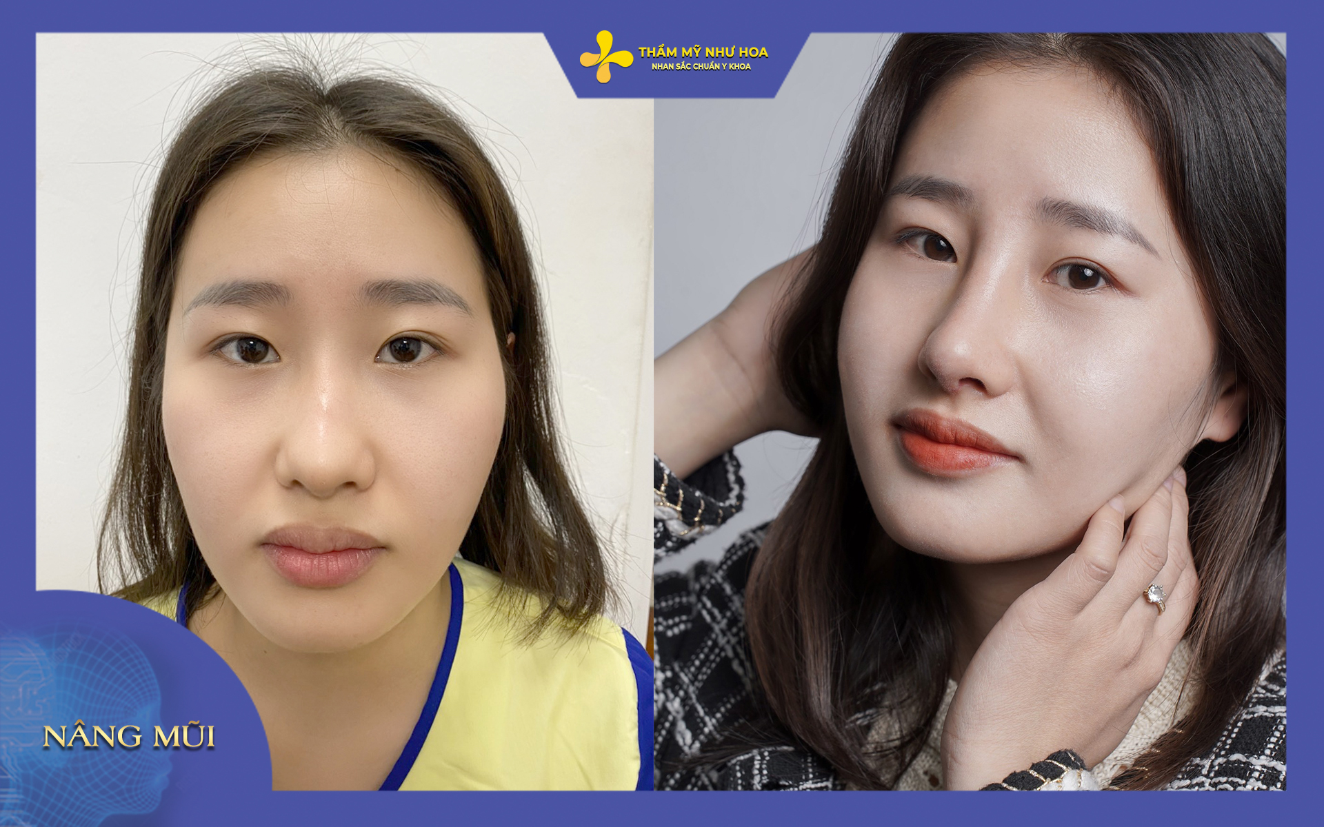 hình ảnh trước và sau khi khách hàng chỉnh sửa dáng mũi củ tỏi tại thẩm mỹ Như Hoa