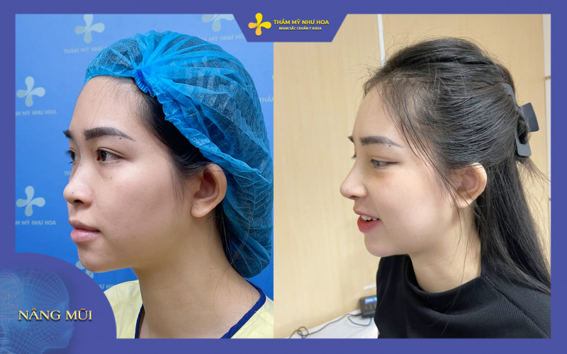hình ảnh của khách hàng trước và sau khi sửa mũi diều hâu tại Thẩm mỹ như Hoa 6