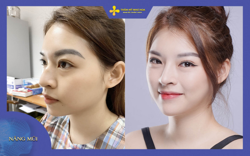 hình ảnh của khách hàng trước và sau khi sửa mũi diều hâu tại Thẩm mỹ như Hoa 1