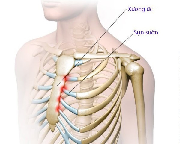  Nâng mũi sụn sườn có vĩnh viễn không, khi nào nên thực hiện? (Hình minh họa)