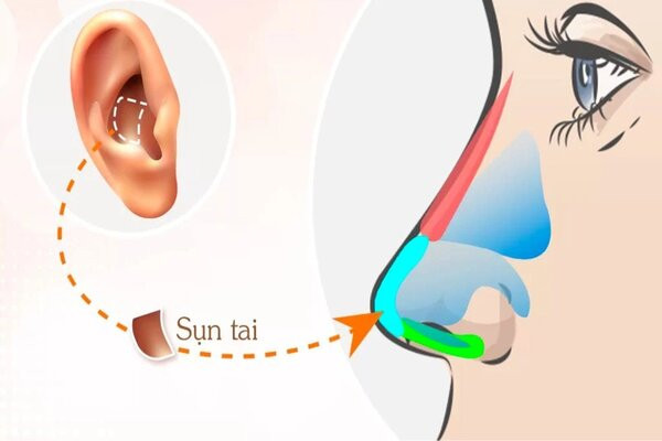 Nâng mũi bọc sụn và ưu điểm của bọc sụn