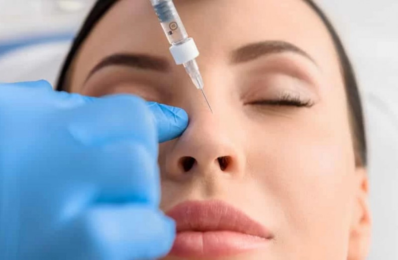 Tiêm filler mũi bị sưng là hiện tượng hoàn toàn bình thường (hình ảnh minh họa)