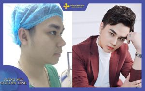Hình ảnh trước và sau nâng mũi của nam được thực hiện tại thẩm mỹ Như Hoa
