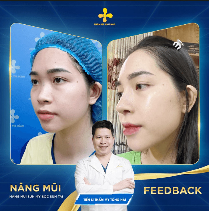 Nâng mũi bọc sụn tự thân tại thẩm mỹ Như Hoa