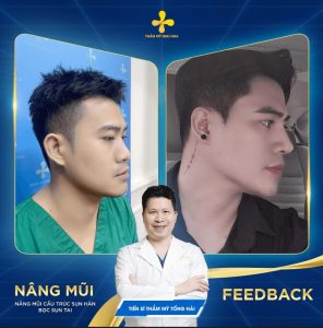 Nâng mũi là nhu cầu phổ biến hiện nay ở nam giới
