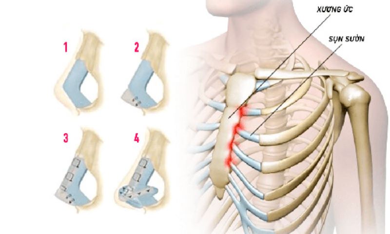 Sụn sườn dùng trong nâng mũi