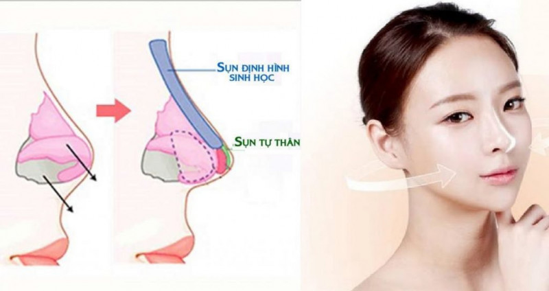 Nên lựa chọn nâng mũi sụn nhân tạo hay sụn tự thân?