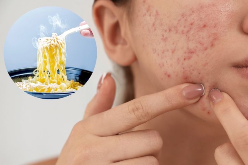 Ăn mì tôm sau nâng mũi dễ gây nóng, bị nổi mụn