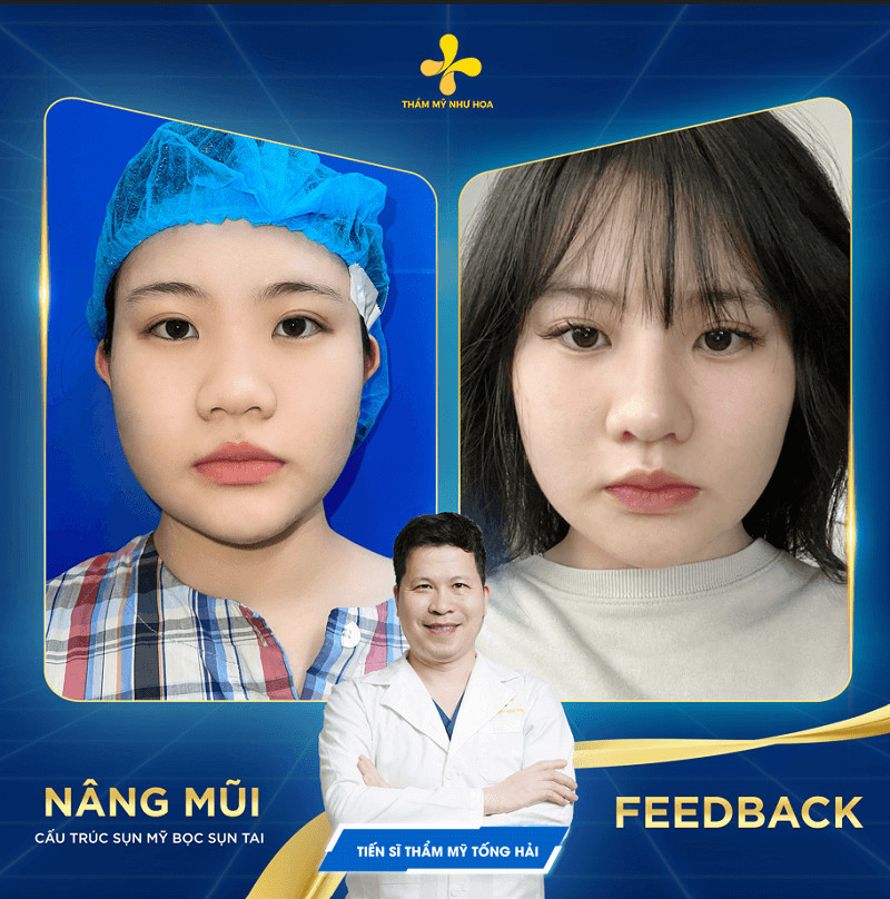 Những hình ảnh trước và sau của các khách hàng đã thực hiện nâng mũi tại thẩm mỹ Như Hoa 1