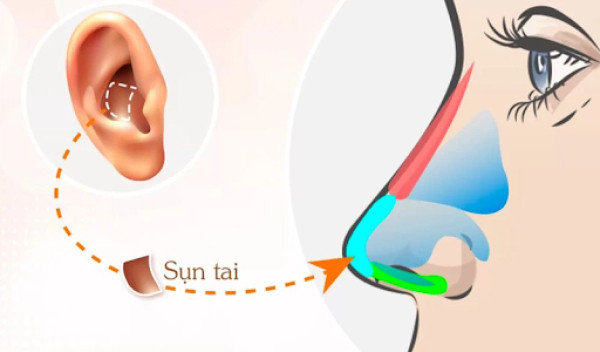 Nâng mũi bằng sụn tai là gì, nâng mũi bằng sụn tai được bao lâu?