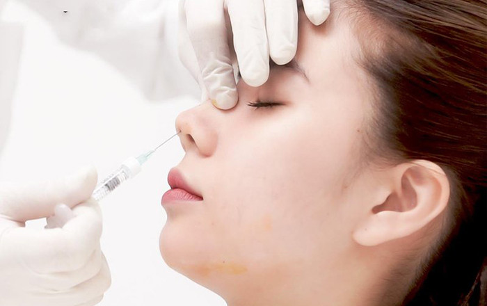 Nâng mũi filler không đảm bảo được tính bền vững lâu dài