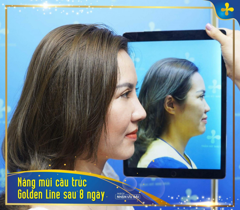 Mũi Golden Line vô cùng tự nhiên của khách hàng sau 8 ngày 