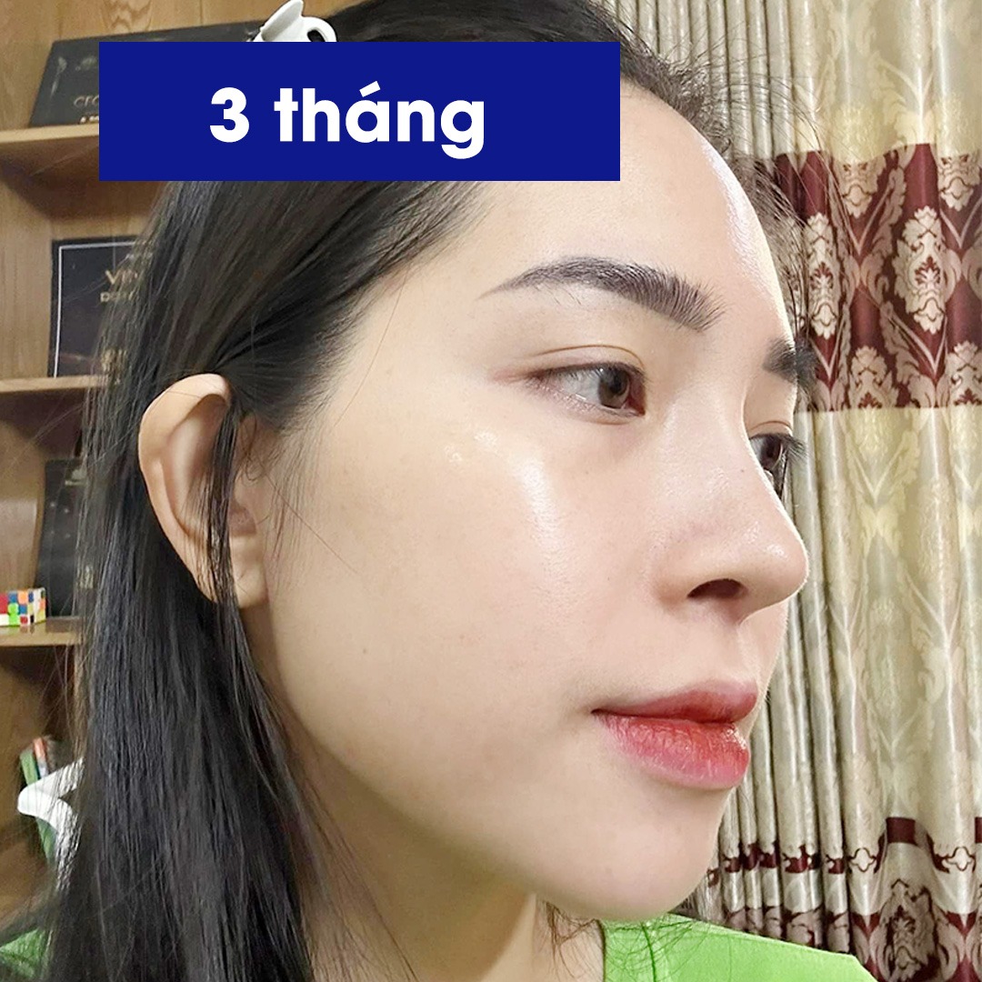 Mũi sau 3 tháng phẫu thuật, có độ bay nhẹ, tự nhiên