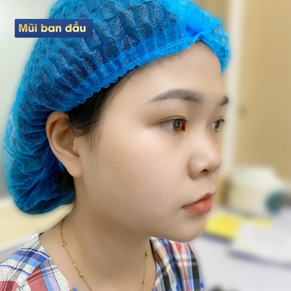 Chị đẹp Lương Đỗ sau khi sử dụng nâng mũi Golden line