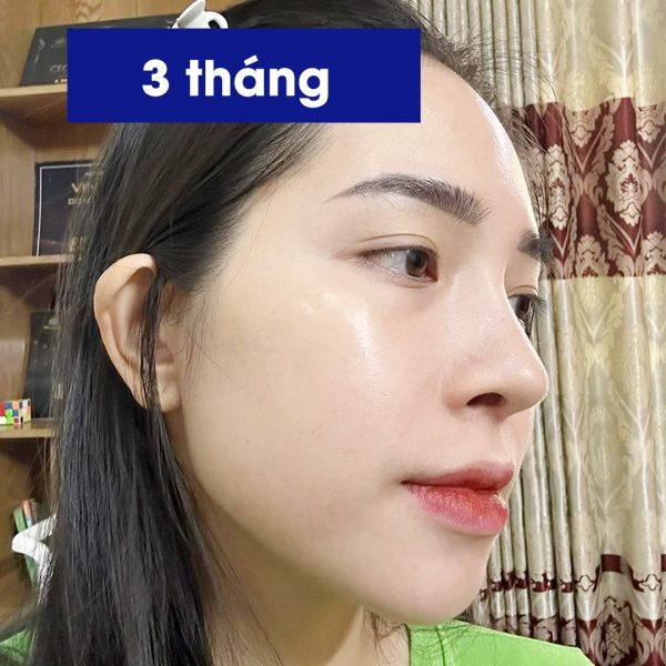 chị đẹp Thanh Ngọc sau nâng mũi