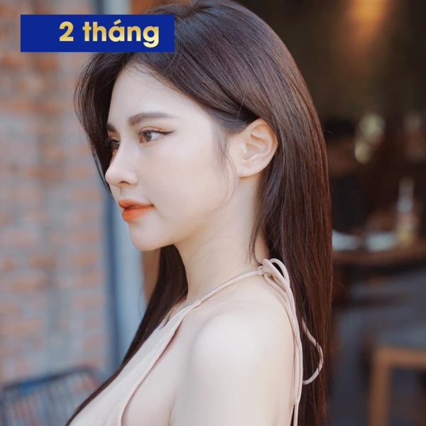 Chị đẹp Thu Thảo sau nâng mũi