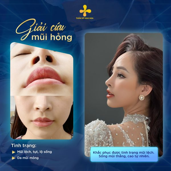 Ca giải cứu mũi hỏng tại Thẩm mỹ Như Hoa
