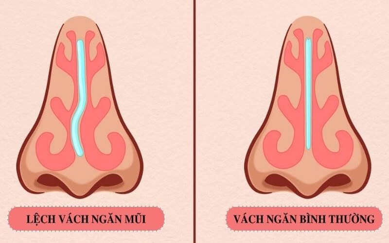 Tình trạng lệch vách ngăn mũi