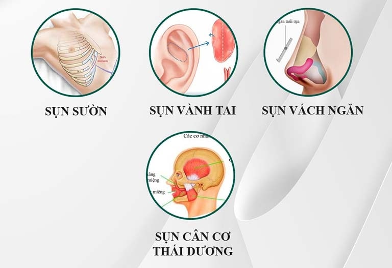 Sụn vách ngăn, sụn tai, sụn cân cơ thái dương giúp tạo hình đầu mũi