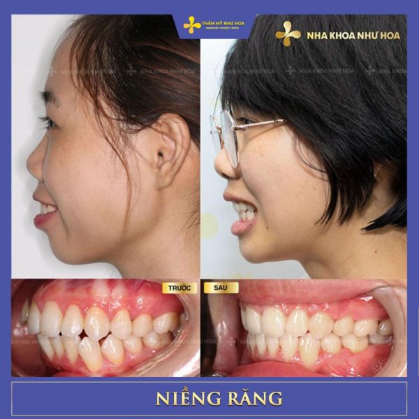 Khách hàng trước và sau niềng răng tại Như Hoa