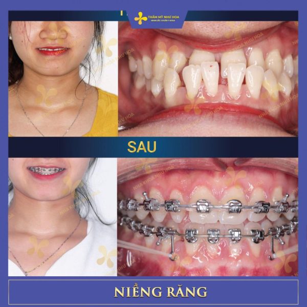 Khách hàng trước và sau niềng răng tại Như Hoa