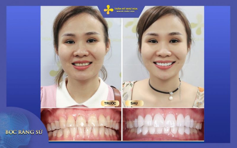 Khách hàng trước và sau bọc răng sứ tại Như Hoa