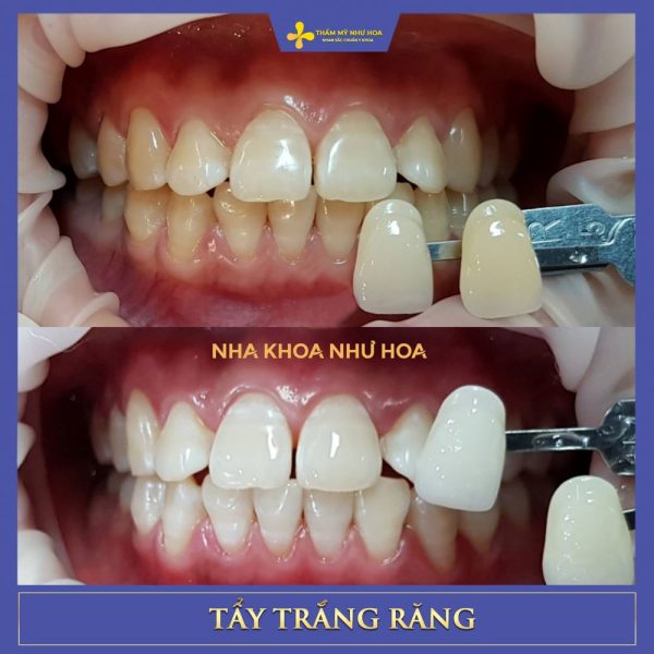 Khách hàng trước và sau khi tẩy trắng răng tại Như Hoa