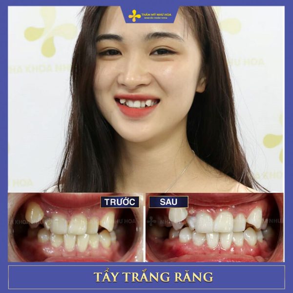 Khách hàng trước và sau khi tẩy trắng răng tại Như Hoa