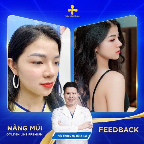 Phẫu thuật nâng mũi giúp khắc phục dáng mũi to
