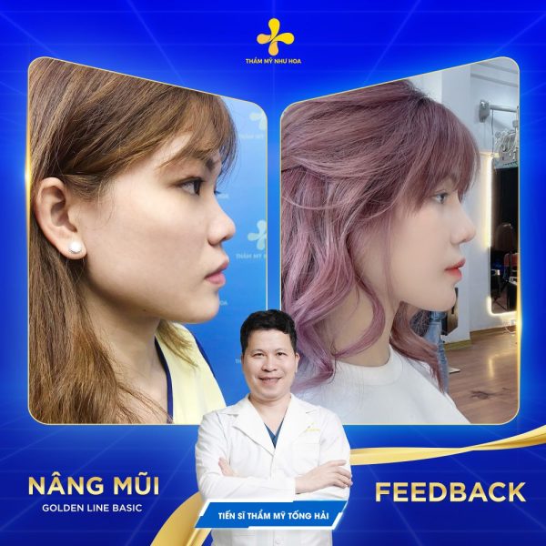 Khách hàng sau khi nâng mũi uy tín tại hà nội