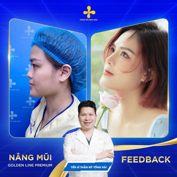 Khách hàng sau khi nâng mũi uy tín tại hà nội