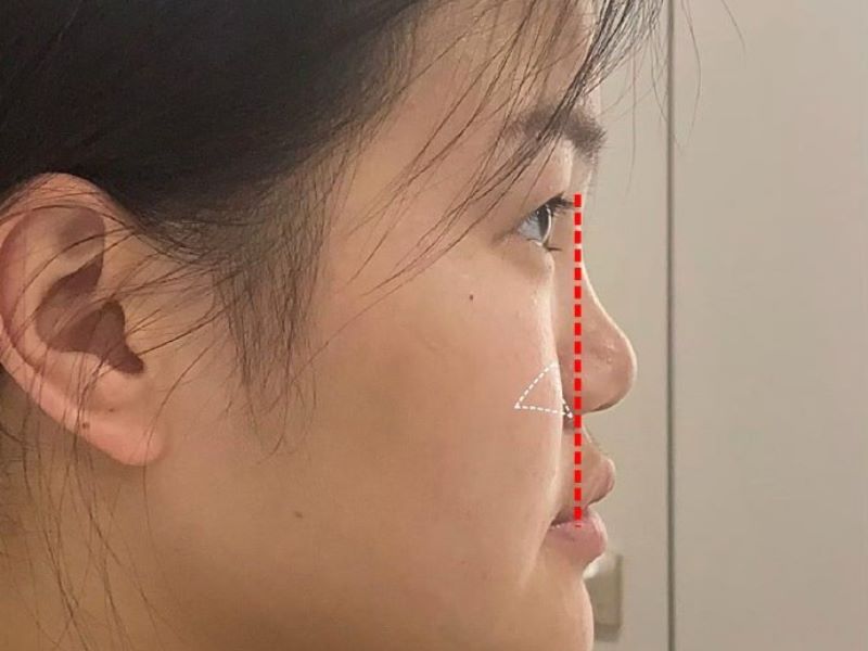 Mũi lõm là nét tướng không được đánh giá cao 