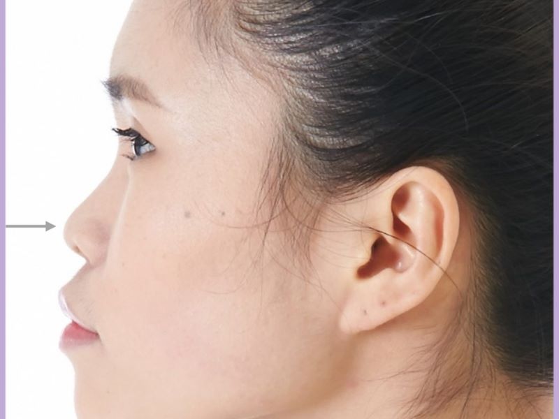 Mũi lõm là tình trạng đầu mũi bị lõm vào so với đường cong thực tế