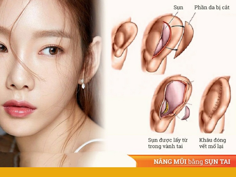 Sụn tai tự thân trong nâng mũi Golden Line Basic
