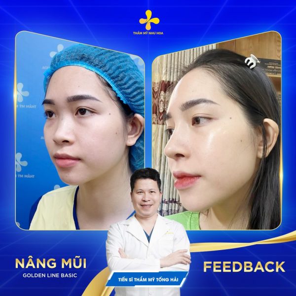 Ưu điểm của phương pháp nâng mũi Golden Line Basic