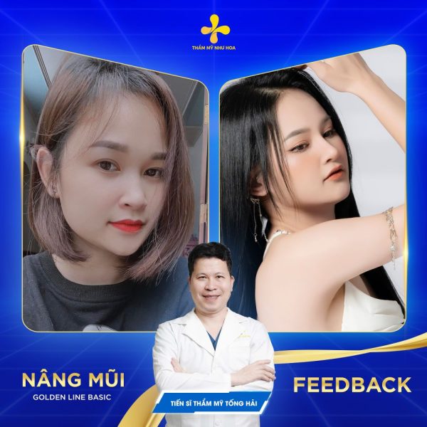 Hình ảnh khách hàng sau nâng mũi Golden Line Basic