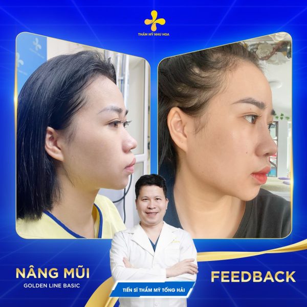 Hình ảnh khách hàng sau nâng mũi Golden Line Basic